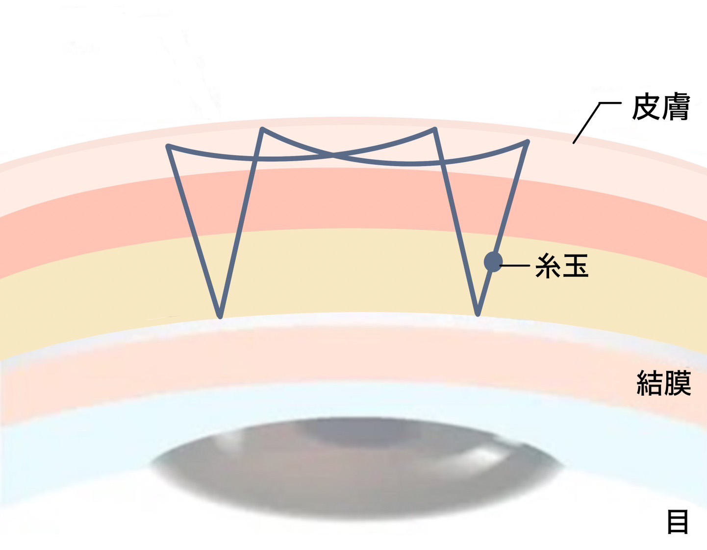 4点線留め