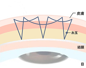 自然癒着法6点線留め