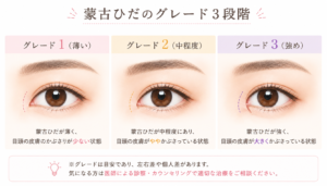 蒙古ひだの強さグレード1〜3の比較イラスト