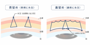 表留めと裏留めの糸玉の位置を比較した模式図