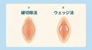 縁切除法とウェッジ法の切除形状比較模式図