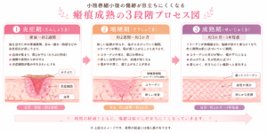 小陰唇縮小後の傷跡が目立ちにくくなる瘢痕成熟の3段階プロセス図
