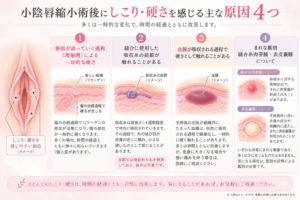 小陰唇縮小術後にしこり・硬さを感じる主な原因を示すイラスト